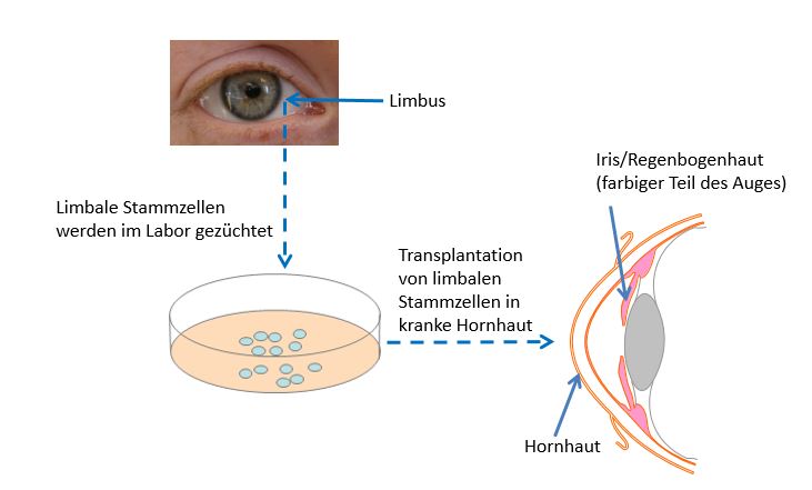 Diagram on repairing the cornea