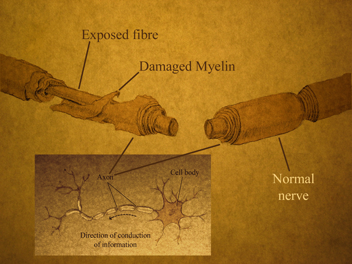 A spinal cord injury affects both neurons and the myelin sheath that insulates axons