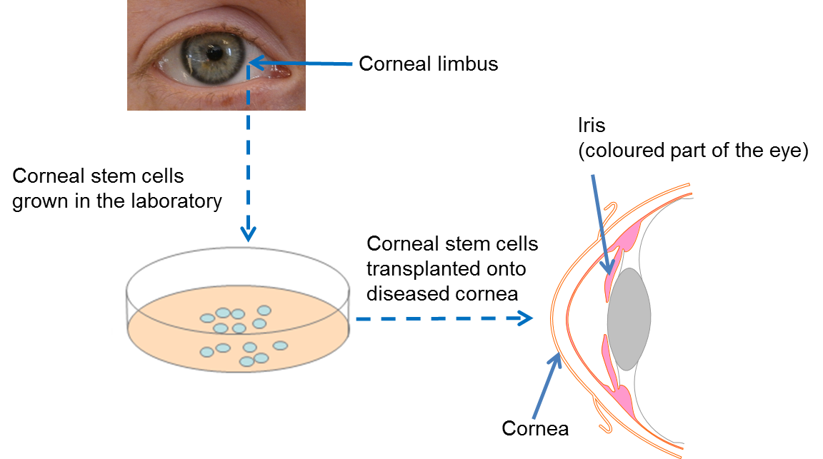 Diagram on repairing the cornea