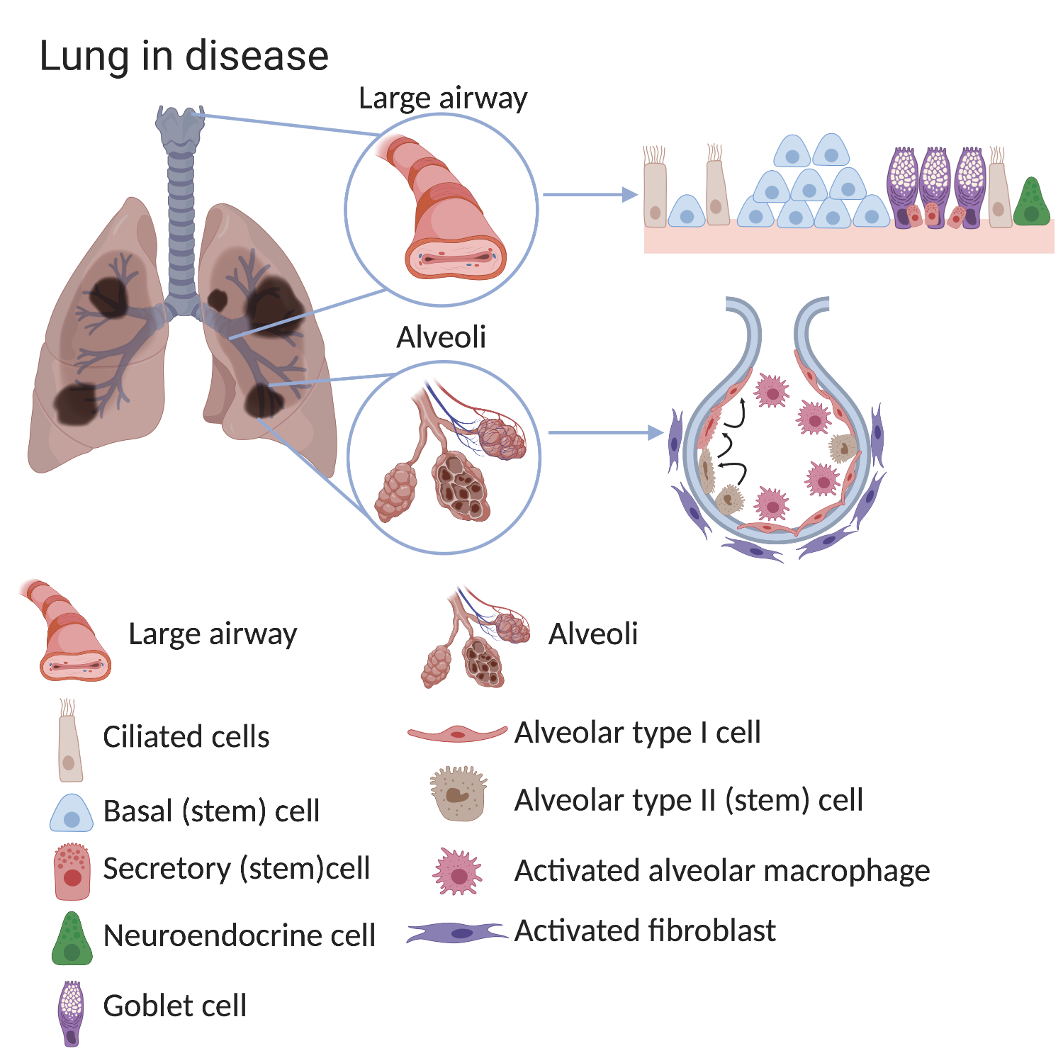 Diagram of stem cells in a diseased lung