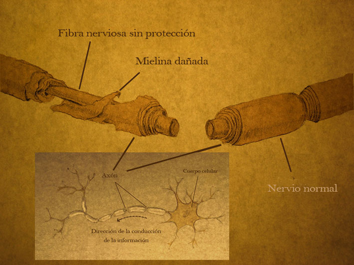 Una lesión de la médula espinal afecta a las neuronas y la vaina de mielina que aísla los axones