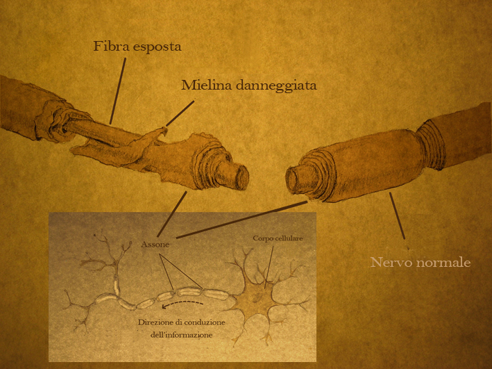 A spinal cord injury affects both neurons and the myelin sheath that insulates axons