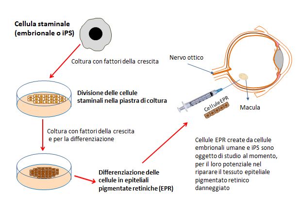 Rimpiazzare le cellule epiteliali pigmentate retiniche