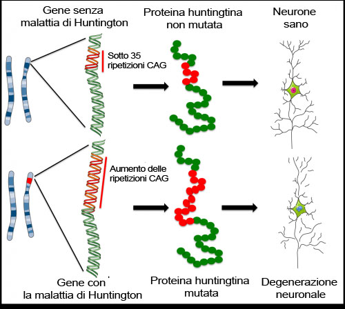 Malattia di Huntington