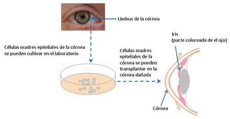 Reparación de la córnea