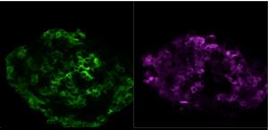 Photo of a human islet where beta and alpha cells are highlighted in green and violet, respectively, using insulin and glucagon antibodies – courtesy Olle Korsgren.