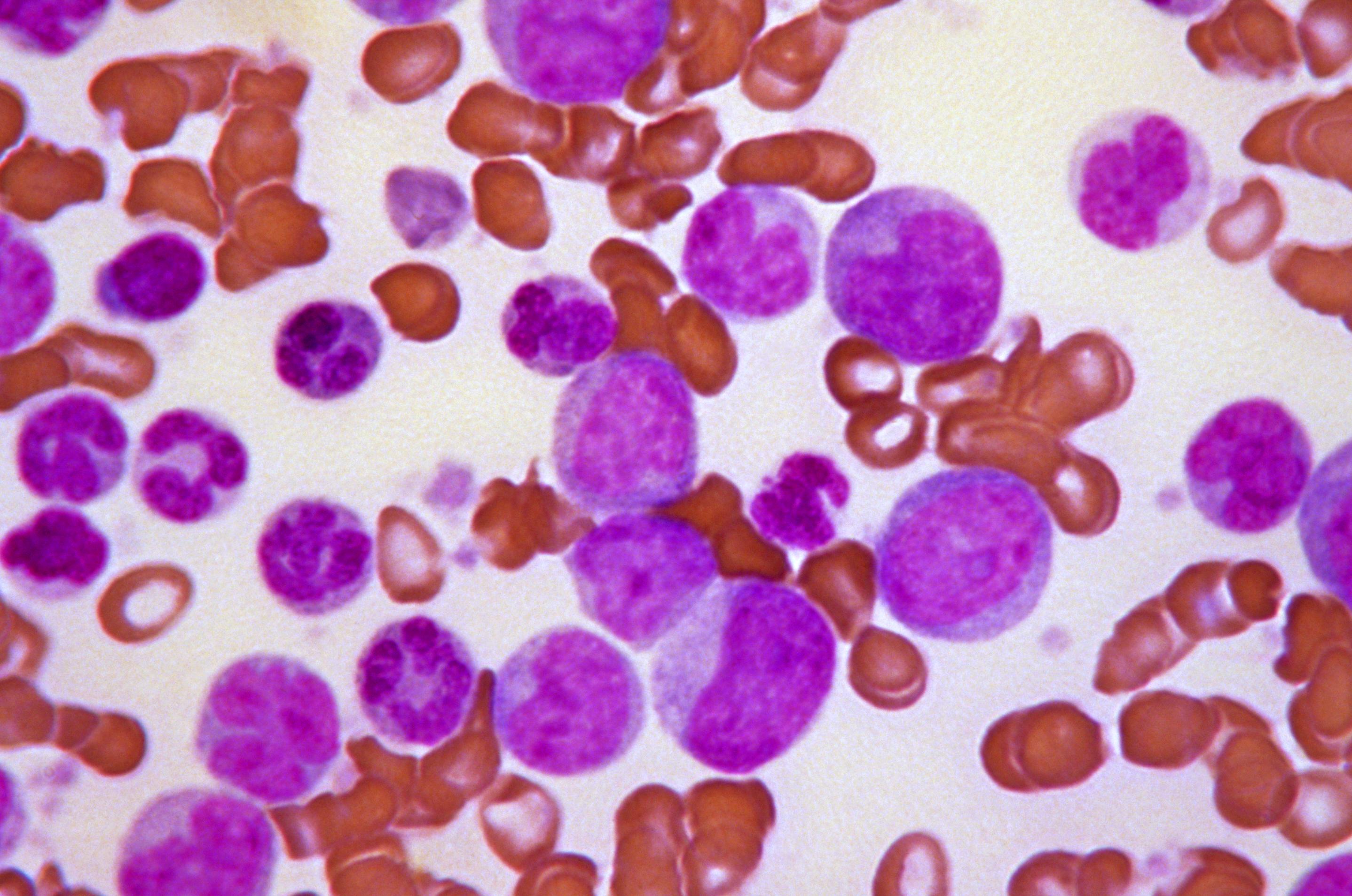 'Blast crisis' in chronic myeloid leukaemia