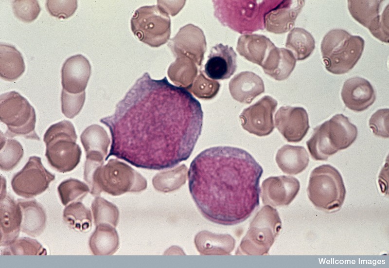 Blood sample from a patient with acute leukaemia