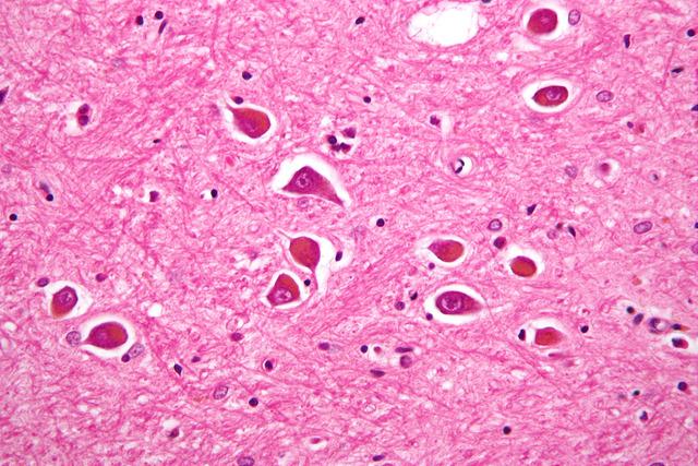 Esta figura representa una imagen aumentada de las células nerviosas llamadas astrocitos (un tipo celular que se encuentra en el cerebro y la médula espinal) cuando están afectadas con la enfermedad de Alzheimer