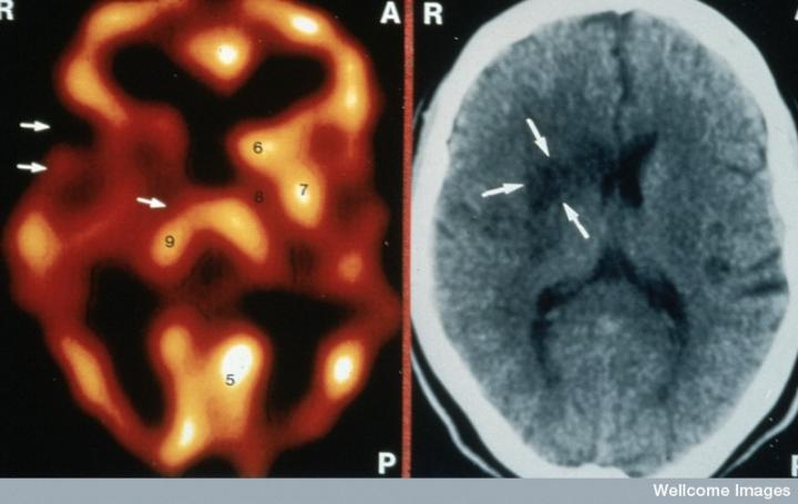 Imagen del cerebro de un paciente con infarto cerebral crónico