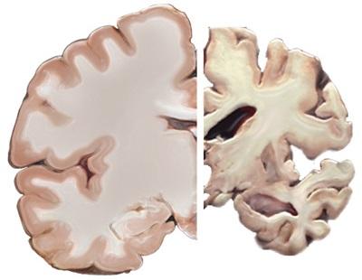 Cerveau sain (gauche) comparé à un cerveau atteint de la maladie d'Alzheimer (droite)