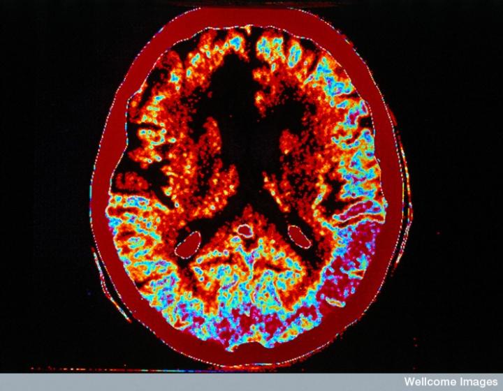 CT scan of brain