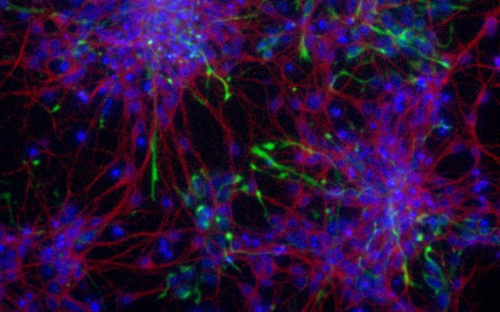 Enfermedad de Huntington: ¿cómo podrían ayudar las células madre?