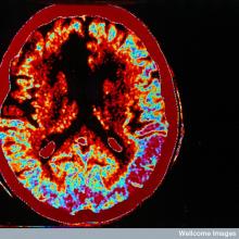 Stroke: how could stem cells help?