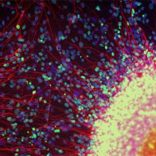 Malattia dei motoneuroni: come possono le cellule staminali aiutare?