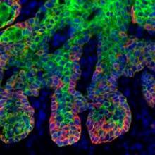 Krebs: eine Krankheit der Stammzellen?