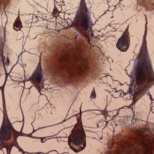La enfermedad de Alzheimer: ¿cómo podrían ayudar las células madre?