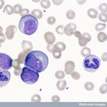 Smear of peripheral blood from a patient with chronic myeloid leukaemia